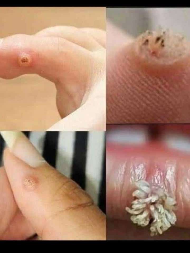 Be Very Careful: If You Notice This Skin Growth, It Could Be Serious