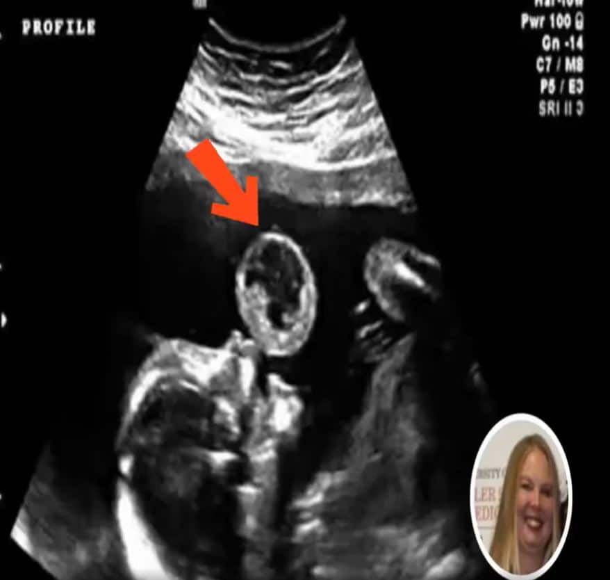 Mom Thinks Her Baby Is Blowing Bubble In Ultrasound, Then Doctors Discover What It Really Is